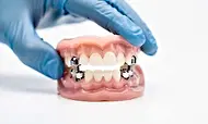 Search For Implant Supported Dentures Near Me (Check It Out)