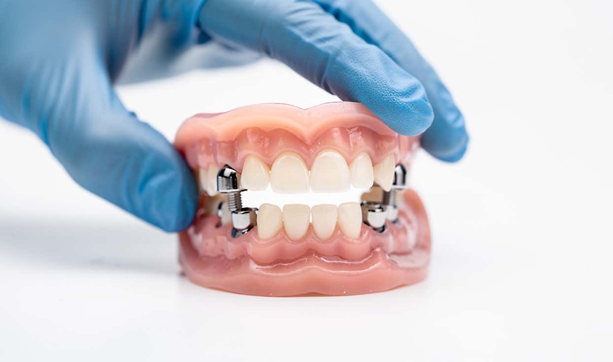Search For Implant Supported Dentures Near Me (Check It Out)
