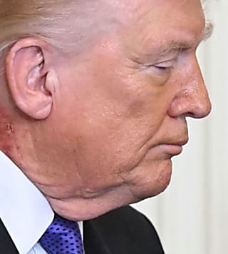 Trump’s neck rash is because of ‘preventative skin treatment,’ his doctor says